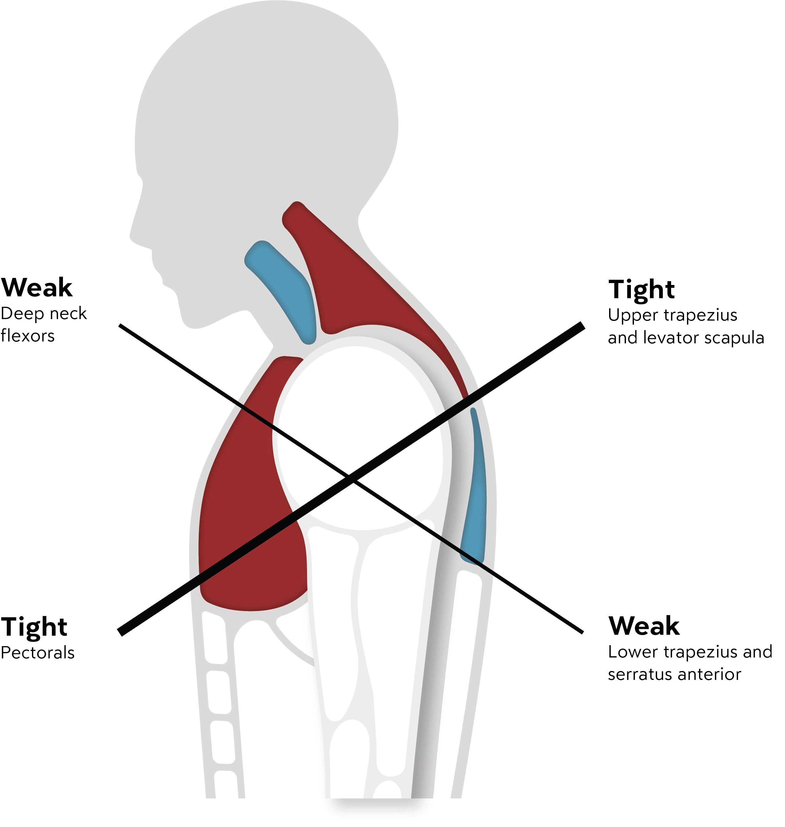 upper_body_muscle_imbalance