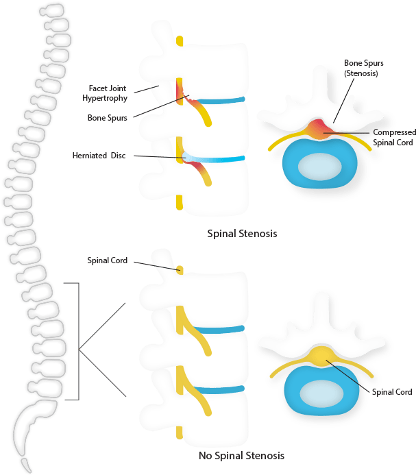 what-is-spinal-stenosis