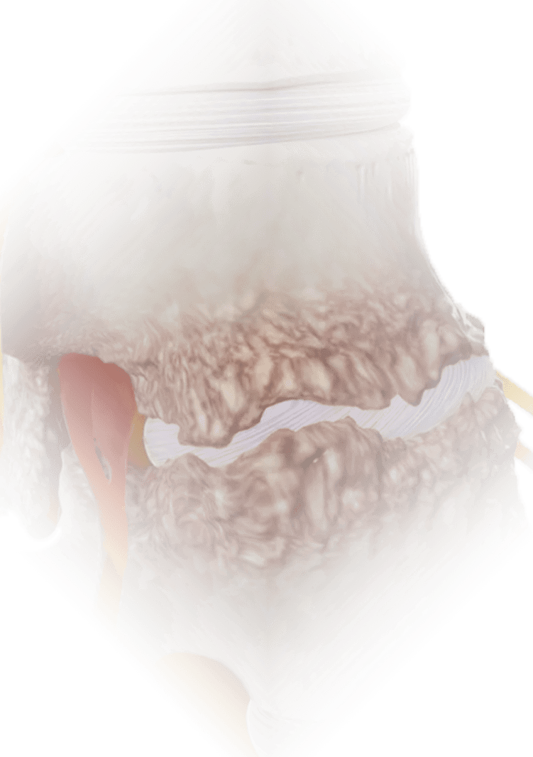 Osteoarthritis