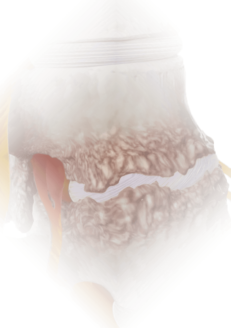 SpinalStenosis