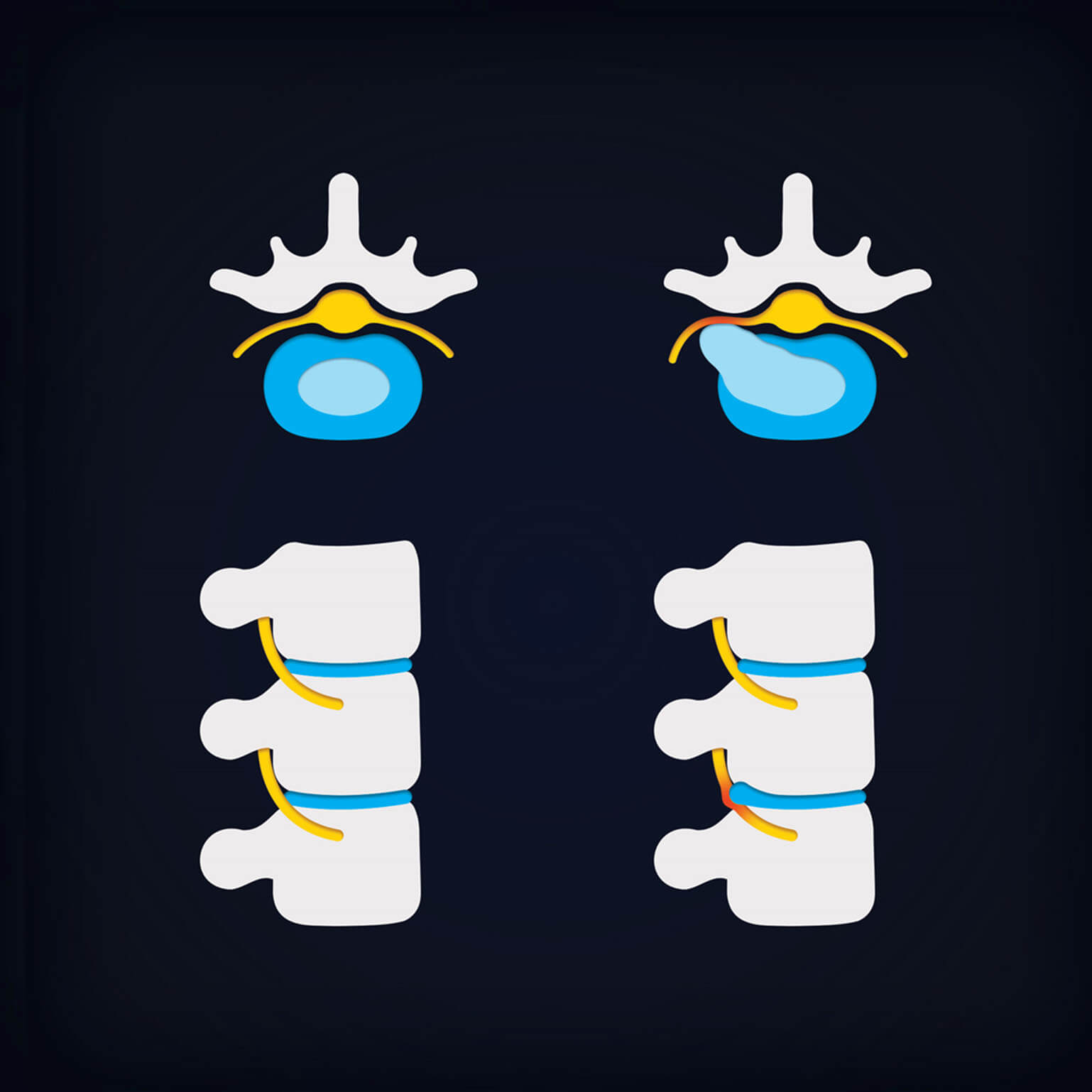herniated-disc