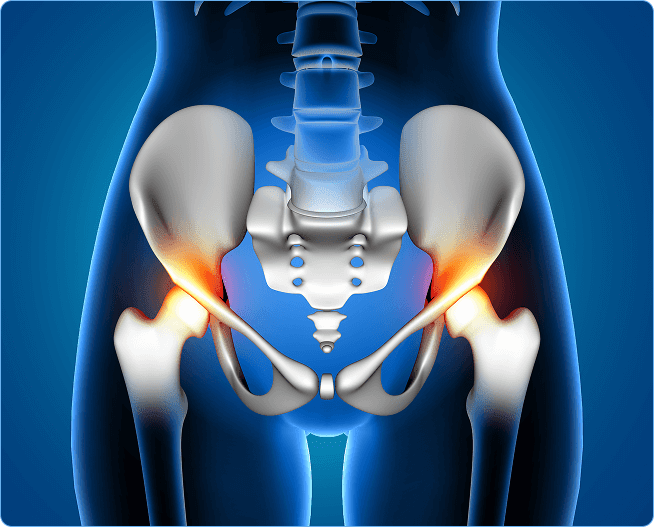 sciatica-img