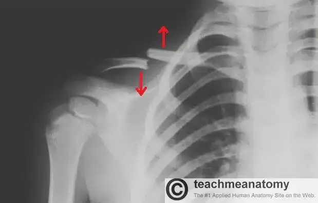 x-ray-of-clavicle-fracture.jpg_r4692q.webp