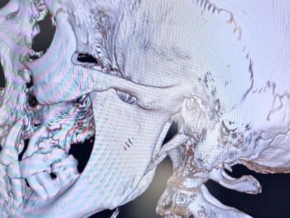 Жителю Татарстана восстановили подвижность нижней челюсти после 28 лет травмы