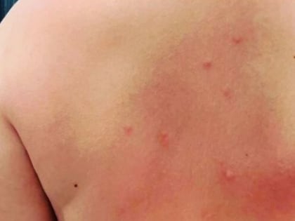 Педиатр Лутфуллин объяснил причину возникновения сыпи у купальщиков с  Изумрудного озера