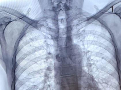 Врач-рентгенолог из Челнов сравнил снимки легких курящего и некурящего человека