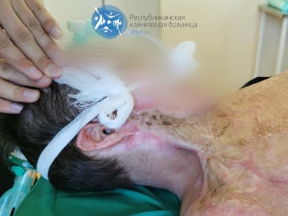 Уникальная операция по пересадке кожи в Татарстане