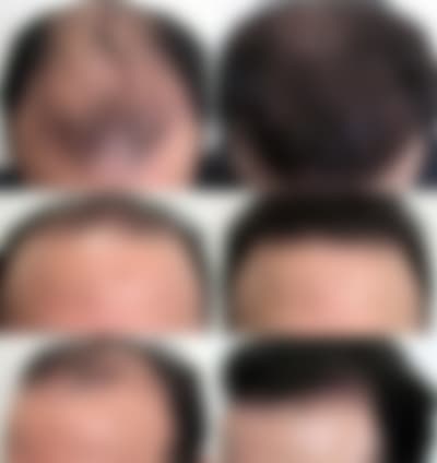 وداعا الفراغات الرأس والصلع