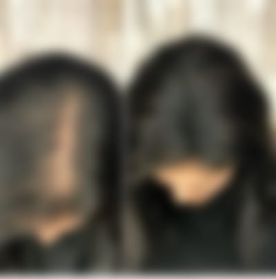 علاج فراغات الشعر 