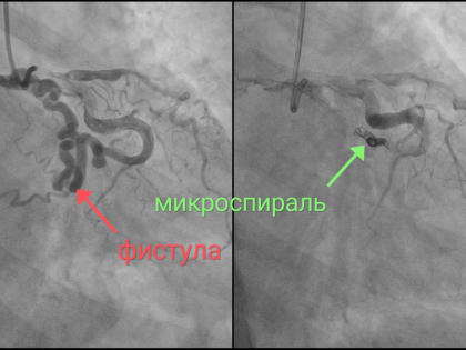 Пожилой новгородке в НОКБ сделали уникальную операцию на сердце