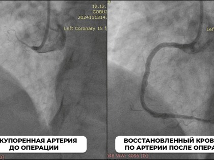 Успешная операция по восстановлению коронарных артерий в Новгородской области