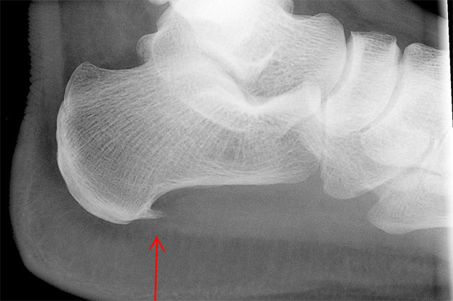 Esperó calcani: què és, símptomes i tractament