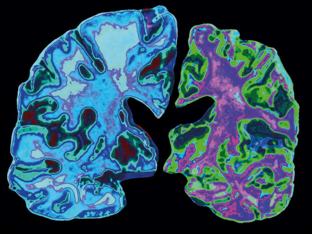 Etapas del Alzheimer: síntomas de cada fase y cuándo actuar
