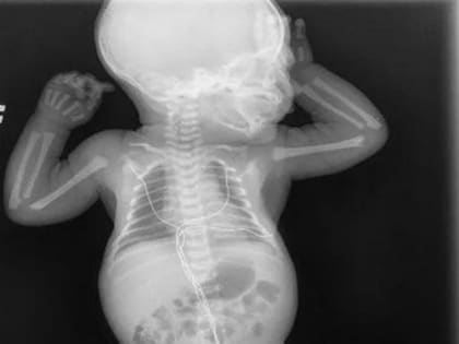 Подмосковные врачи спасли жизнь двум детям