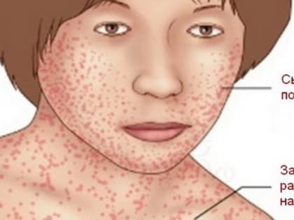 Корь поднимает голову