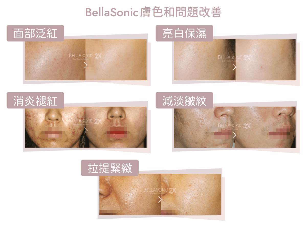 bellasonic功效 泛紅 美白 保濕 退紅