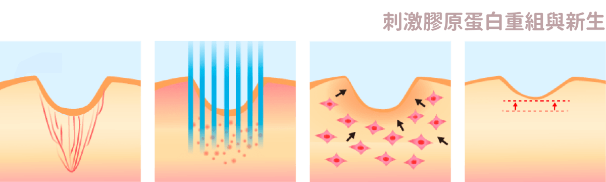 刺激膠原蛋白重組與新生