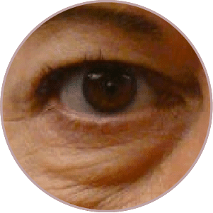 眼袋—淚溝型黑眼圈