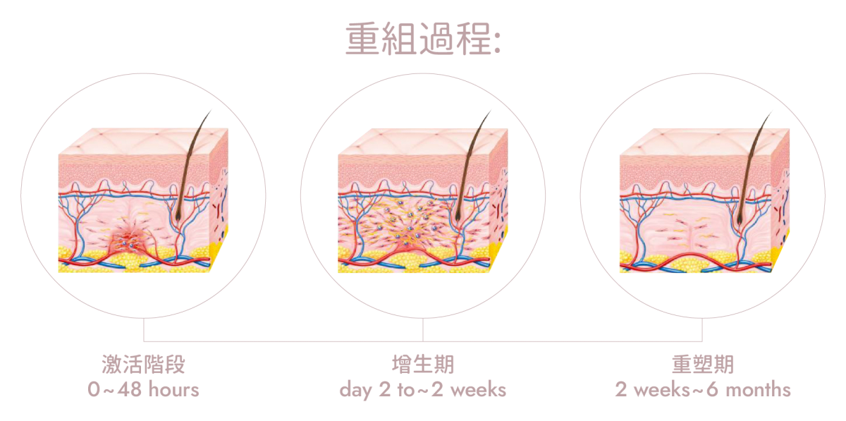 hifu原理 膠原蛋白再生