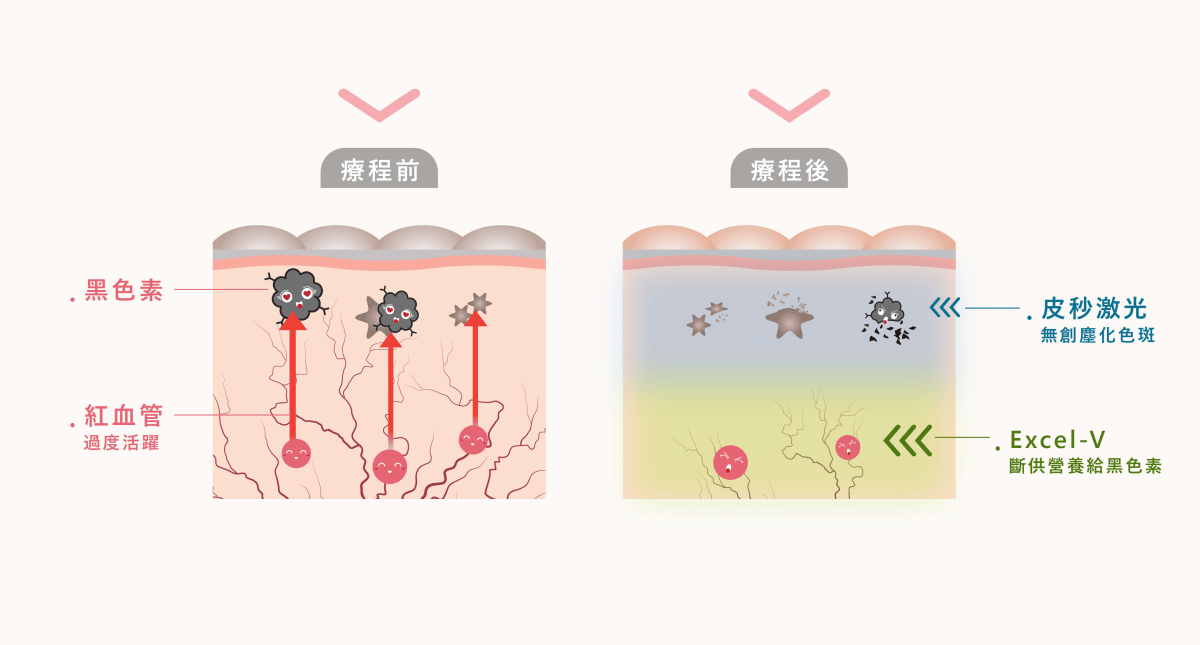 荷爾蒙斑治療方法