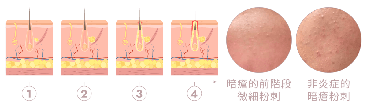 暗瘡反覆發作 教你徹底去瘡去印 | Bora Beauty