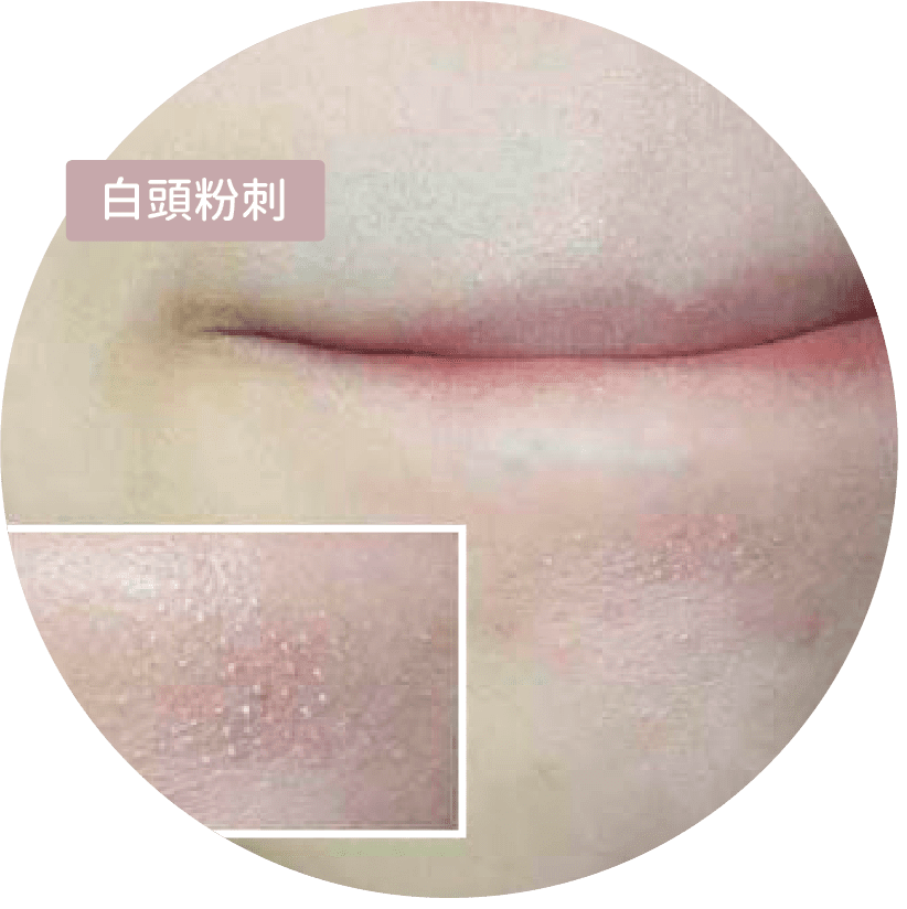 粉刺改善