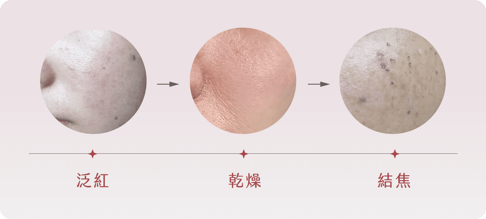 激光去斑副作用