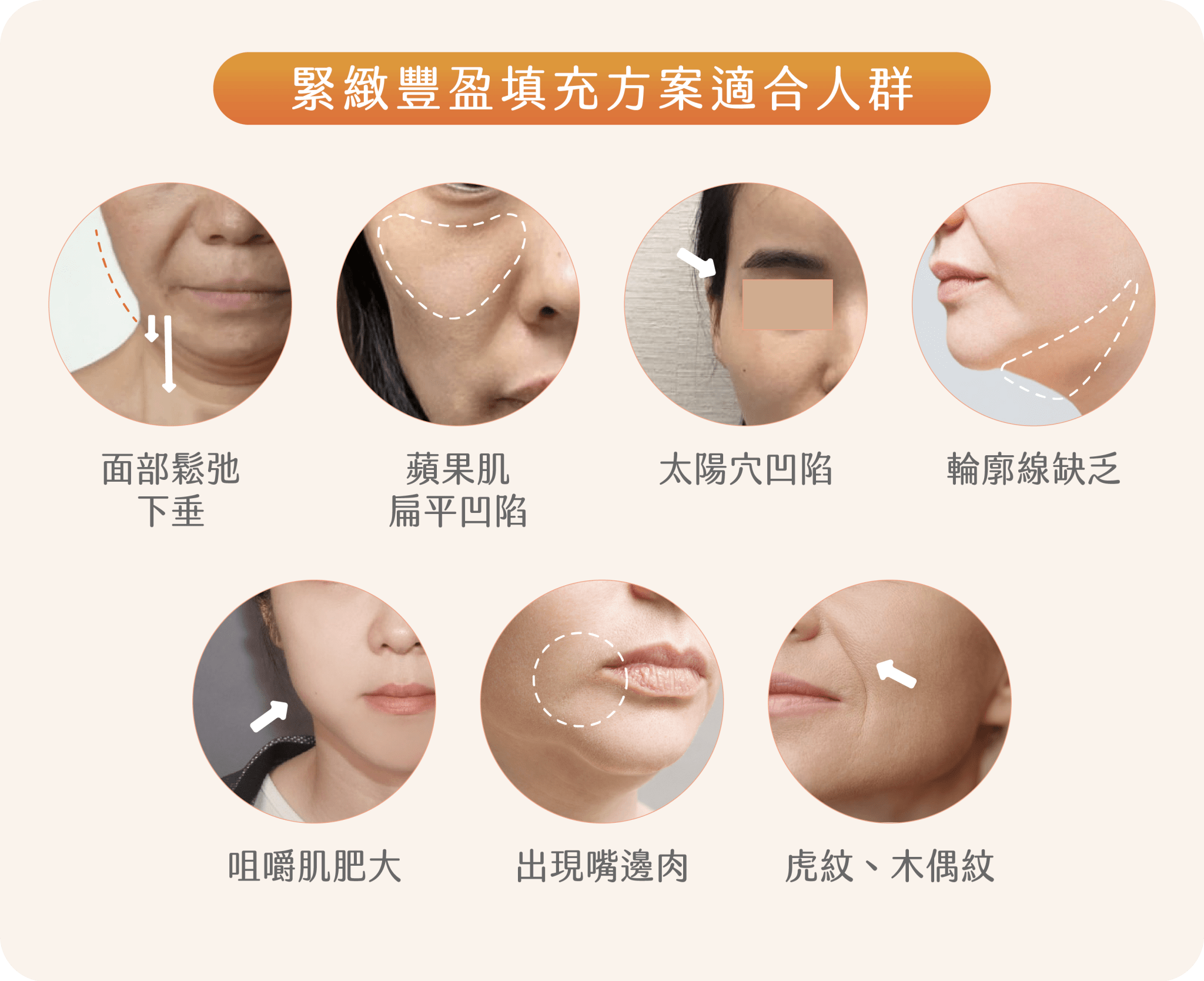 緊緻豐盈填充方案適合人群