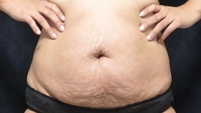 Einxel Plus 膠原修復槍 妊娠紋