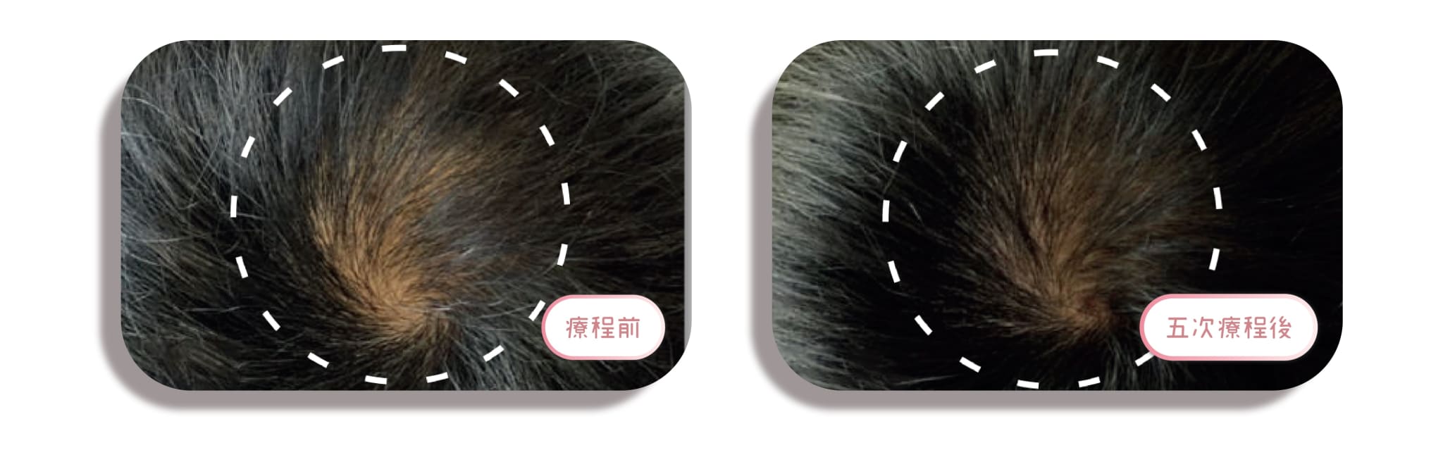 頭髮再生