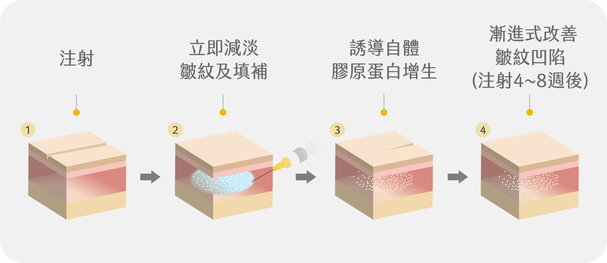 AestheFill®精靈針