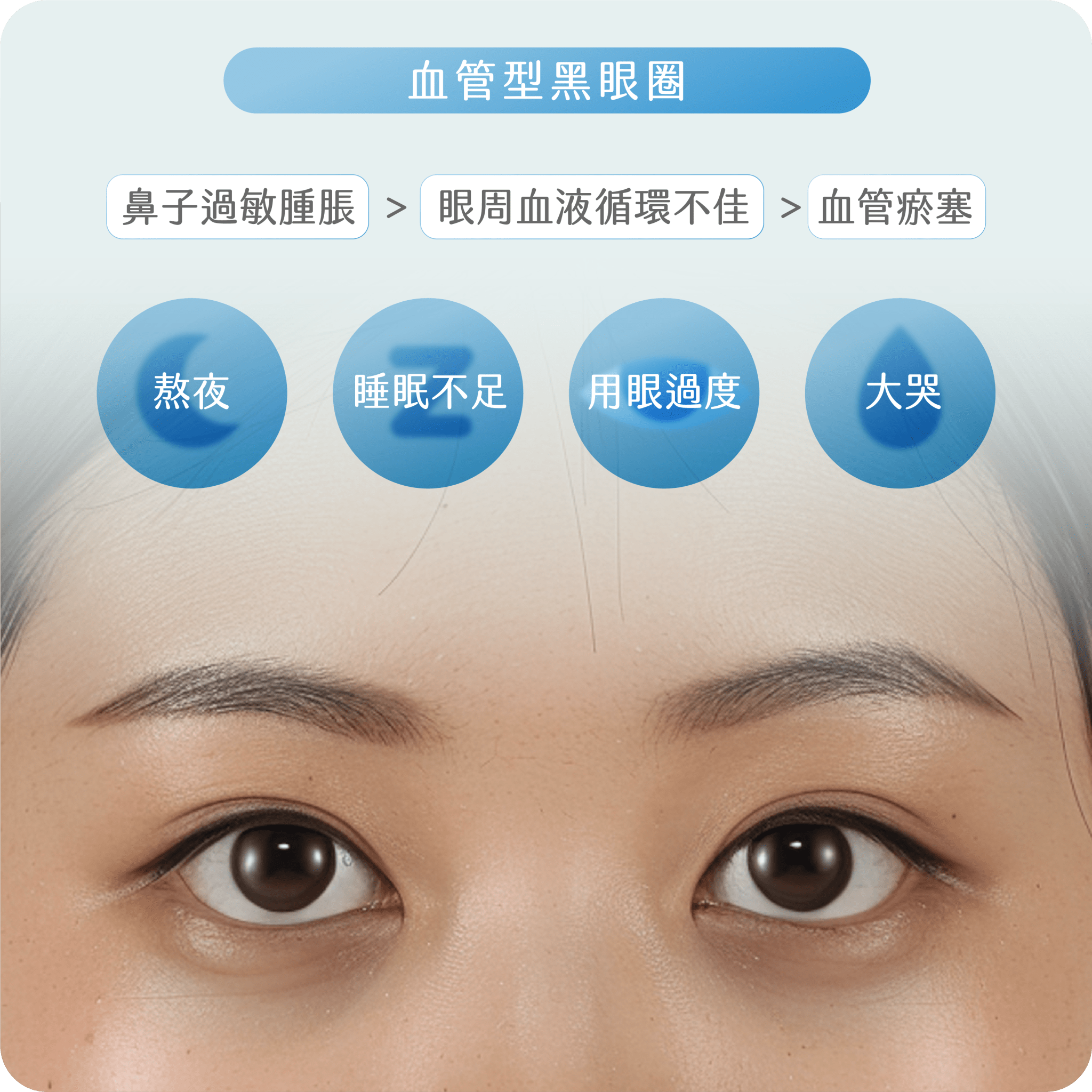 黑眼圈類型