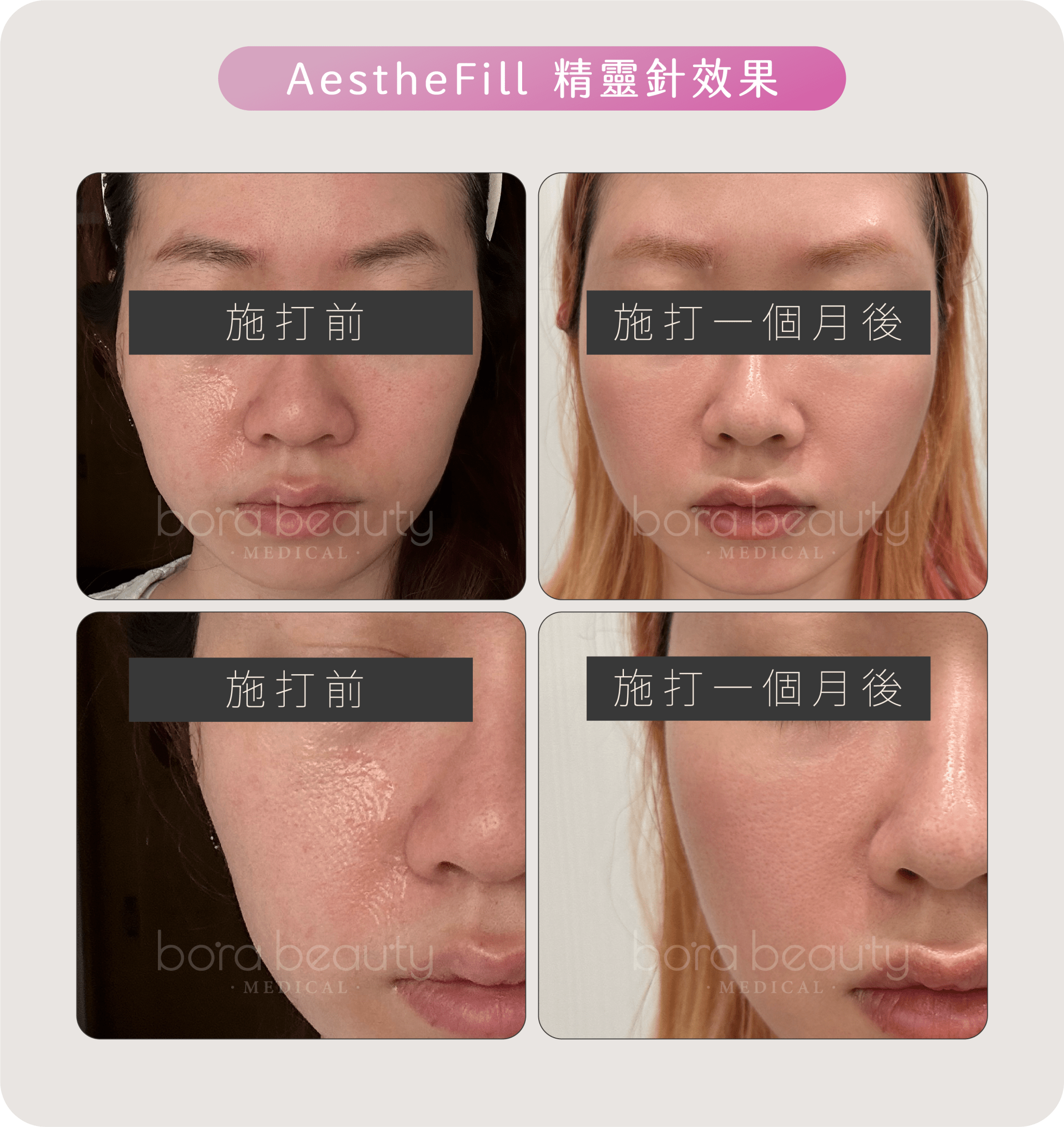 AestheFill 精靈針效果