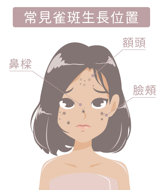 雀斑生長位置