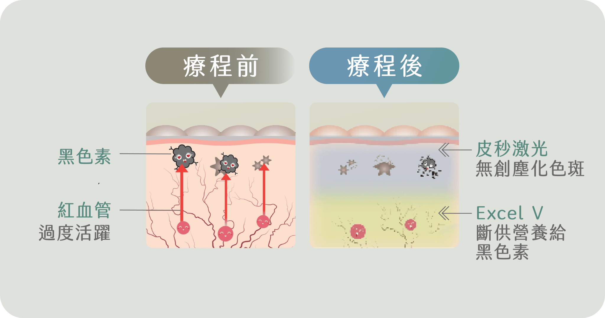 Bora Beauty荷爾蒙斑解決方案實證