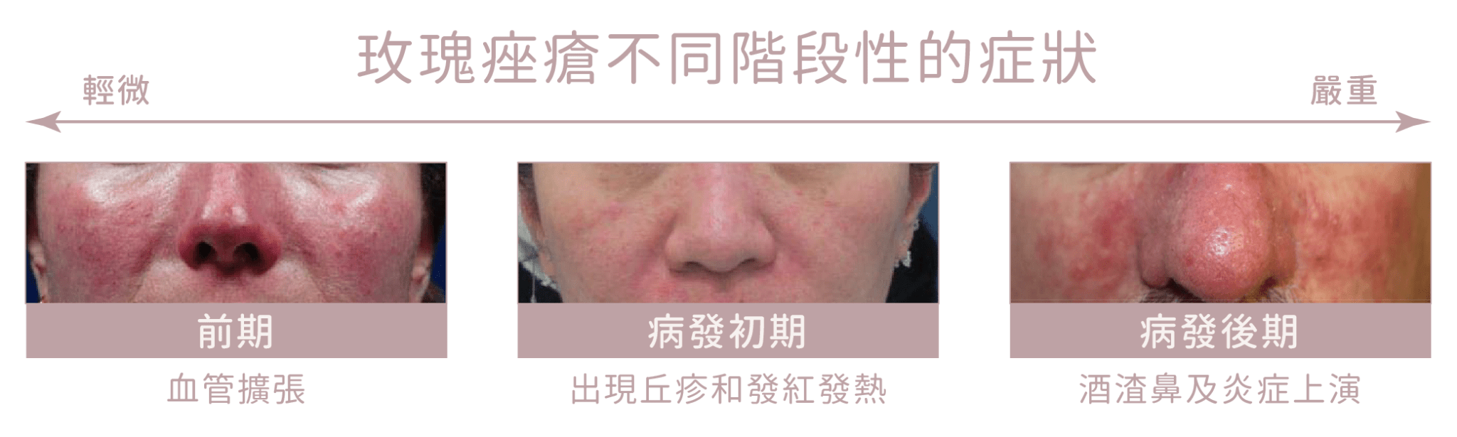 玫瑰痤瘡症狀