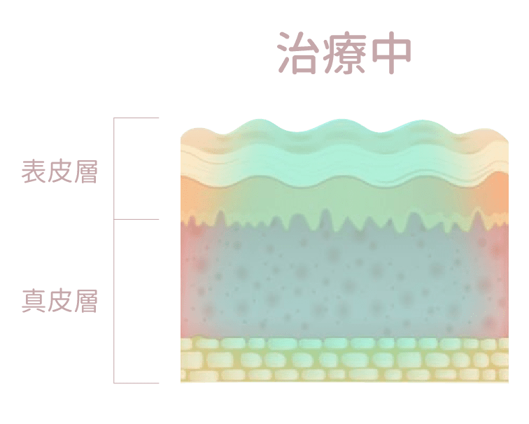 膠原槍 過程