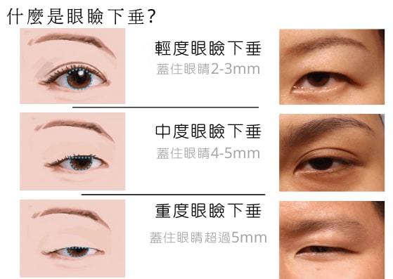 眼瞼下垂