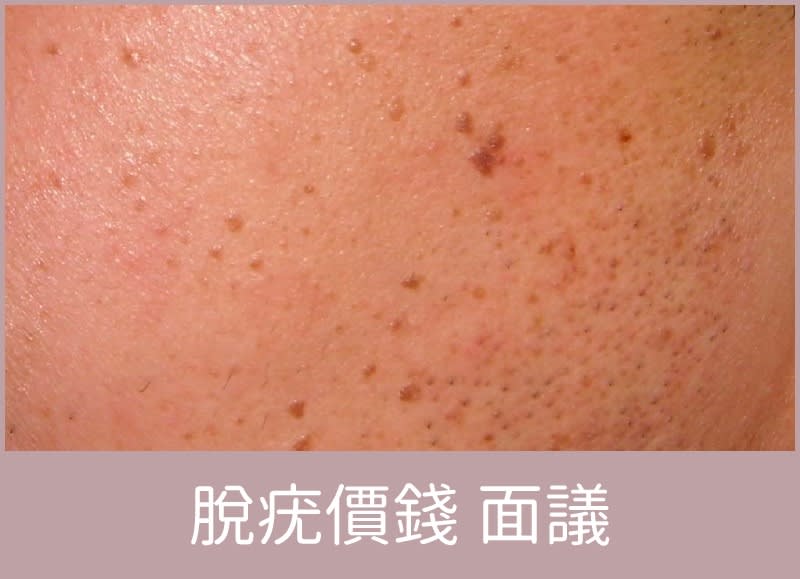 bora beauty脫疣