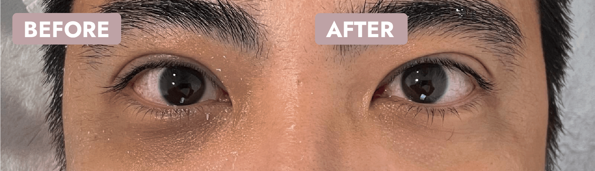 眼袋槍推介 配搭i-firm