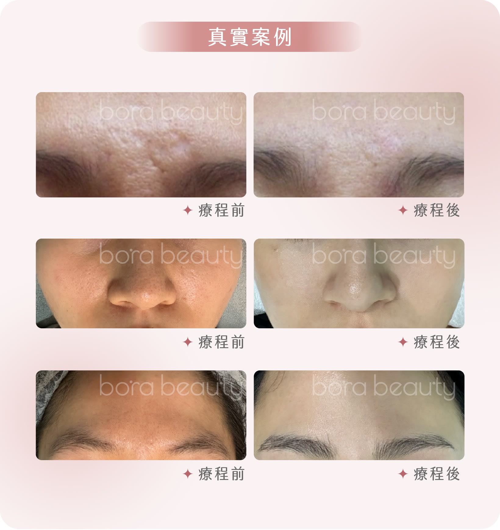 凹凸洞真實案例