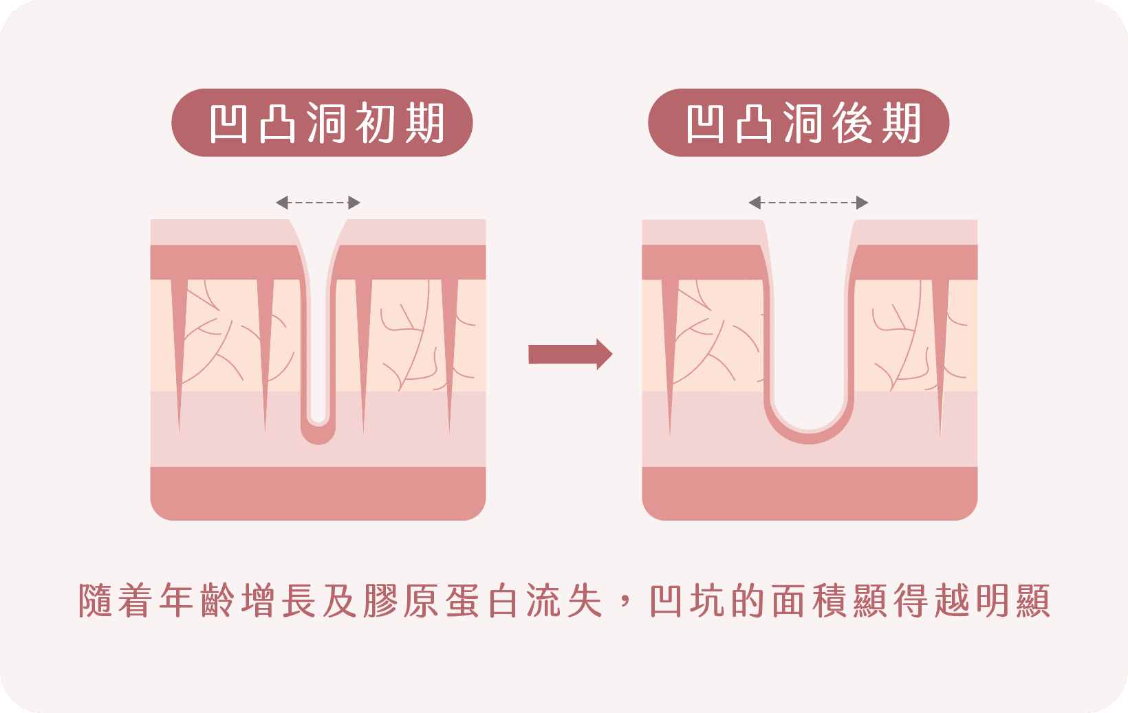 凹凸洞形成過程