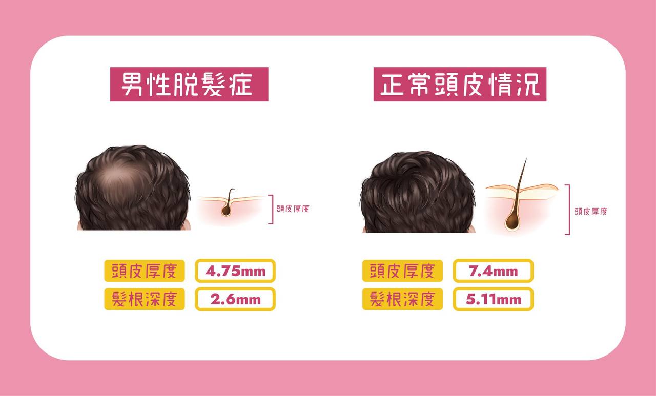 頭皮護理的重要