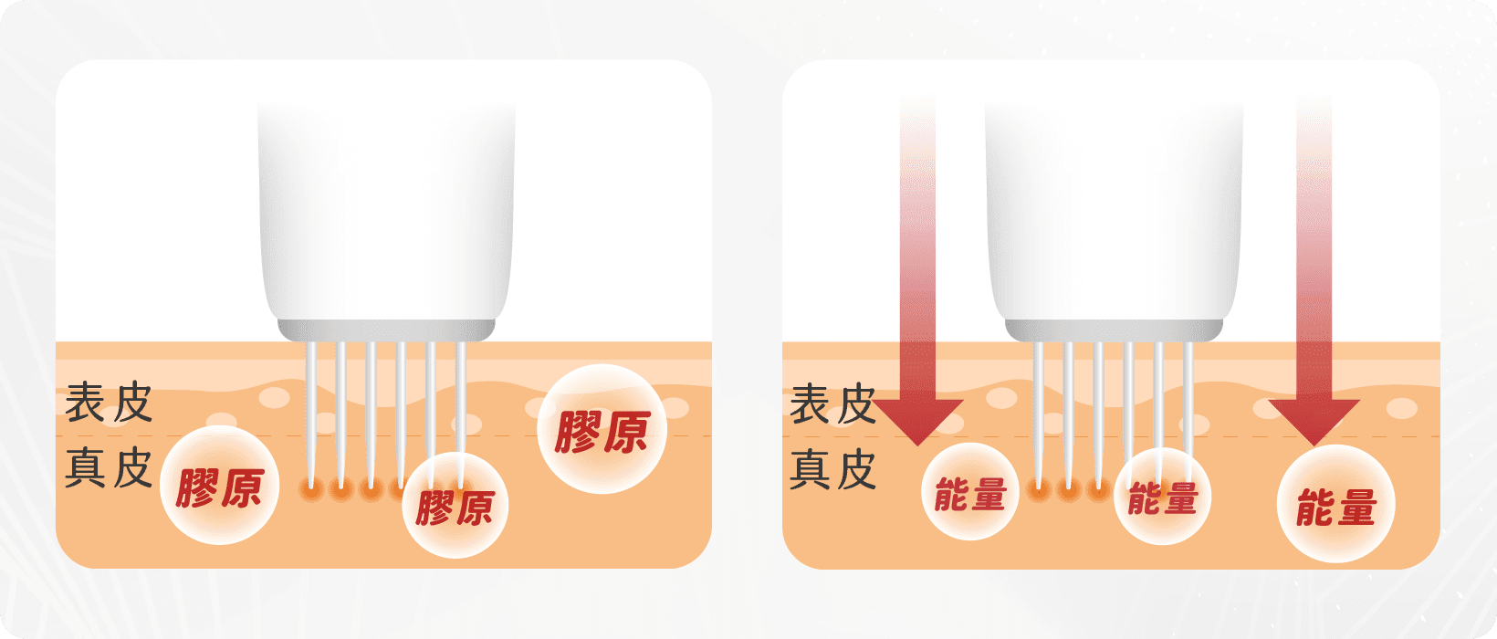 Einxel Plus 膠原修復槍原理
