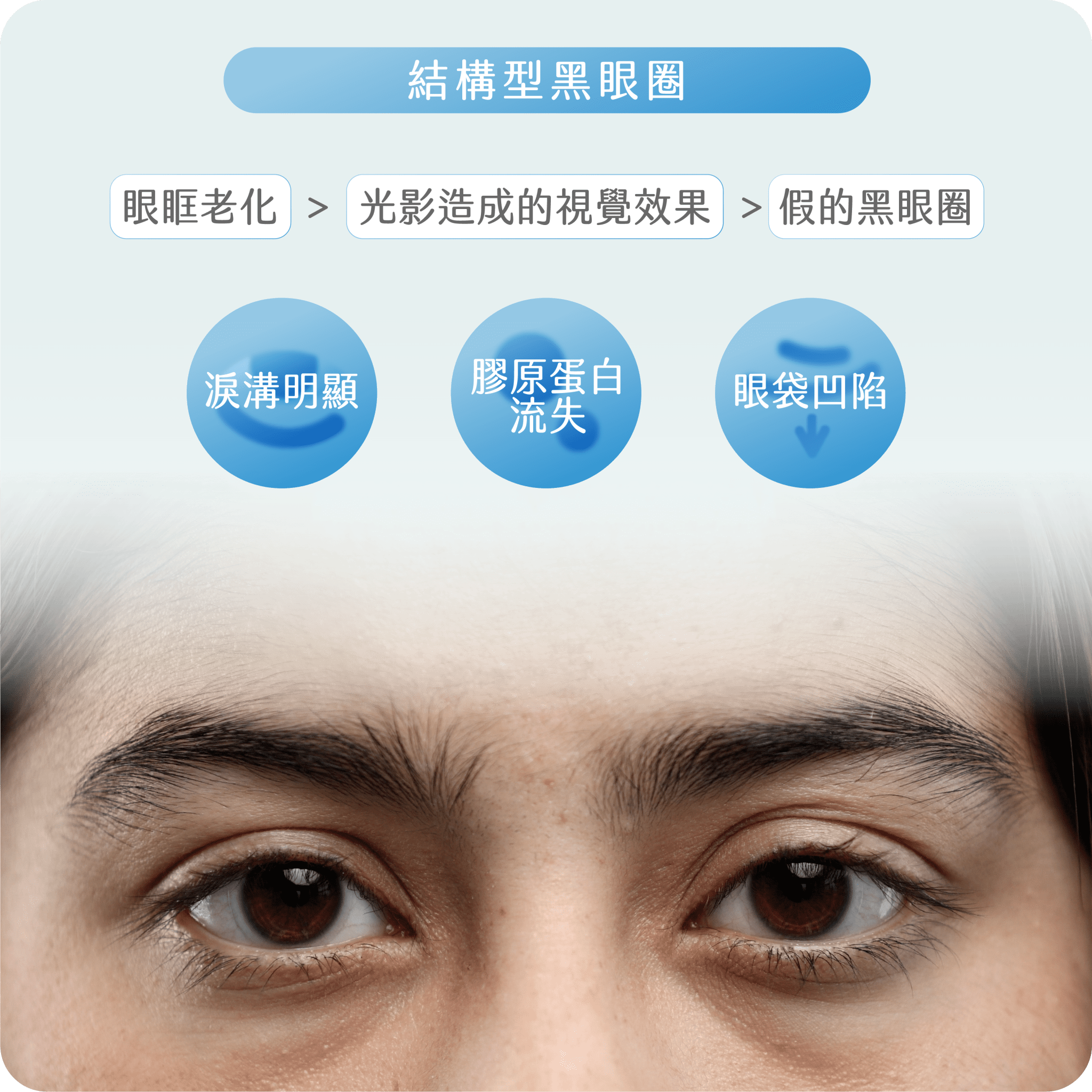 黑眼圈類型
