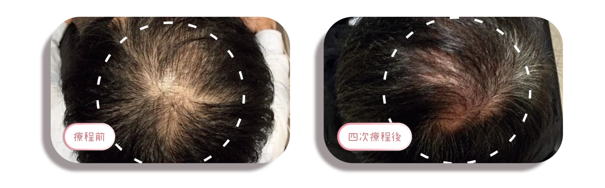 頭髮再生
