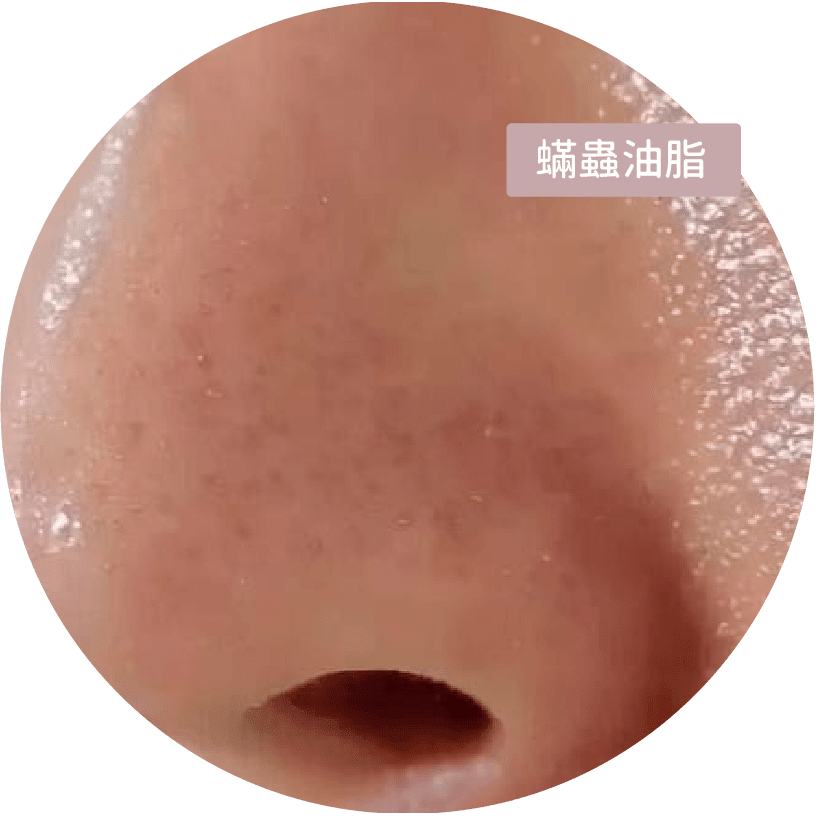 蟎蟲油脂改善