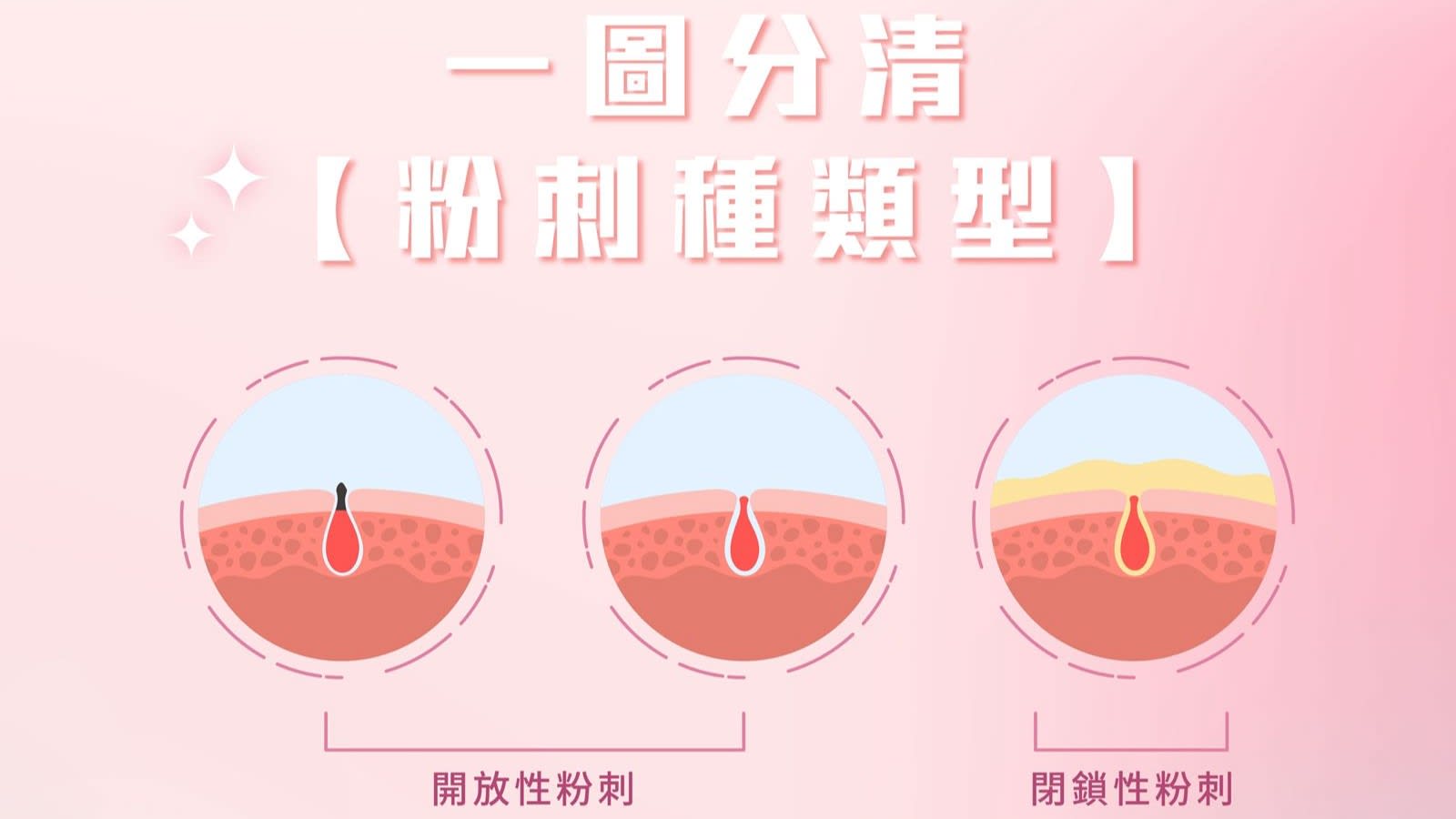 粉刺