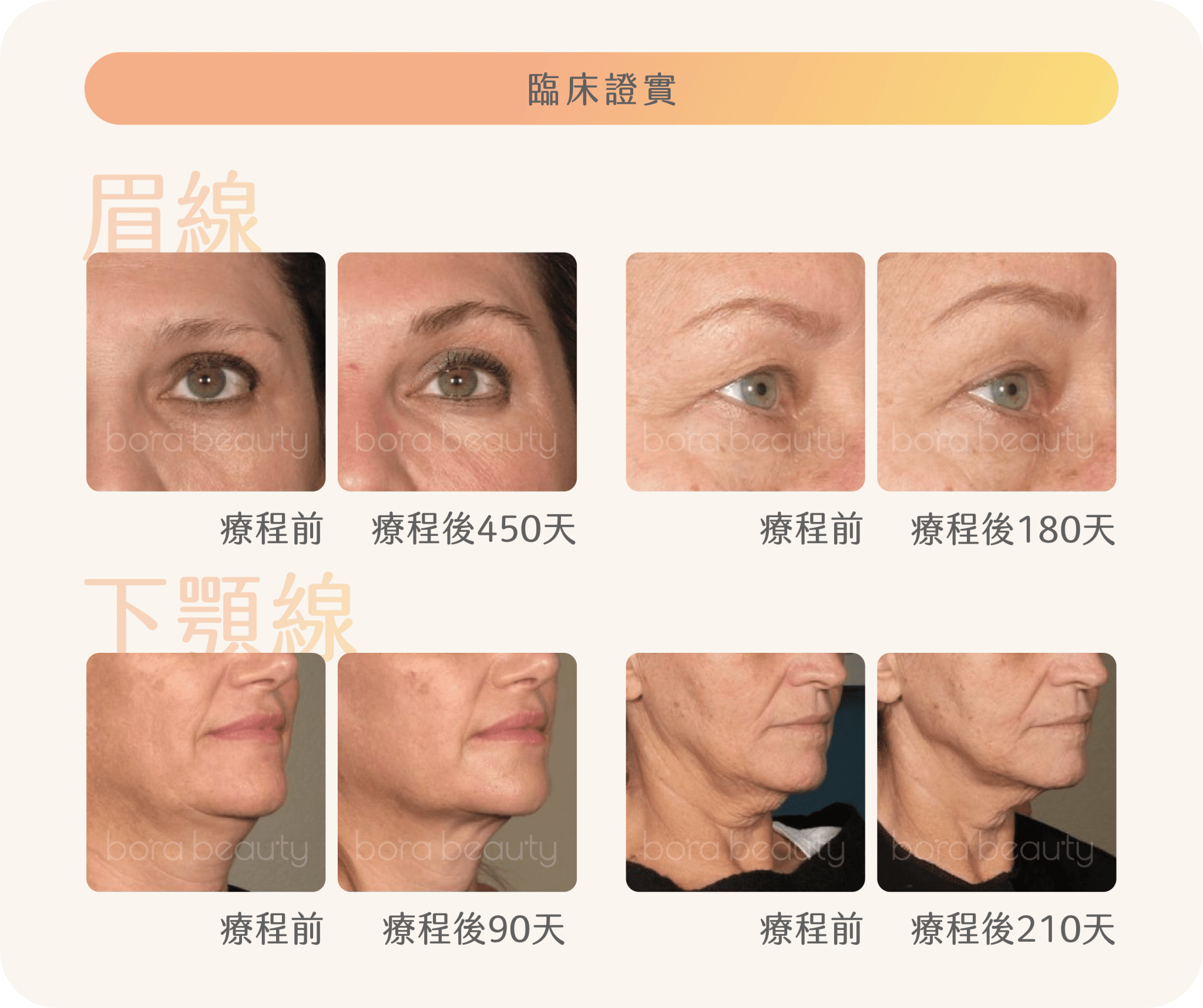 Ultherapy Prime 效果
