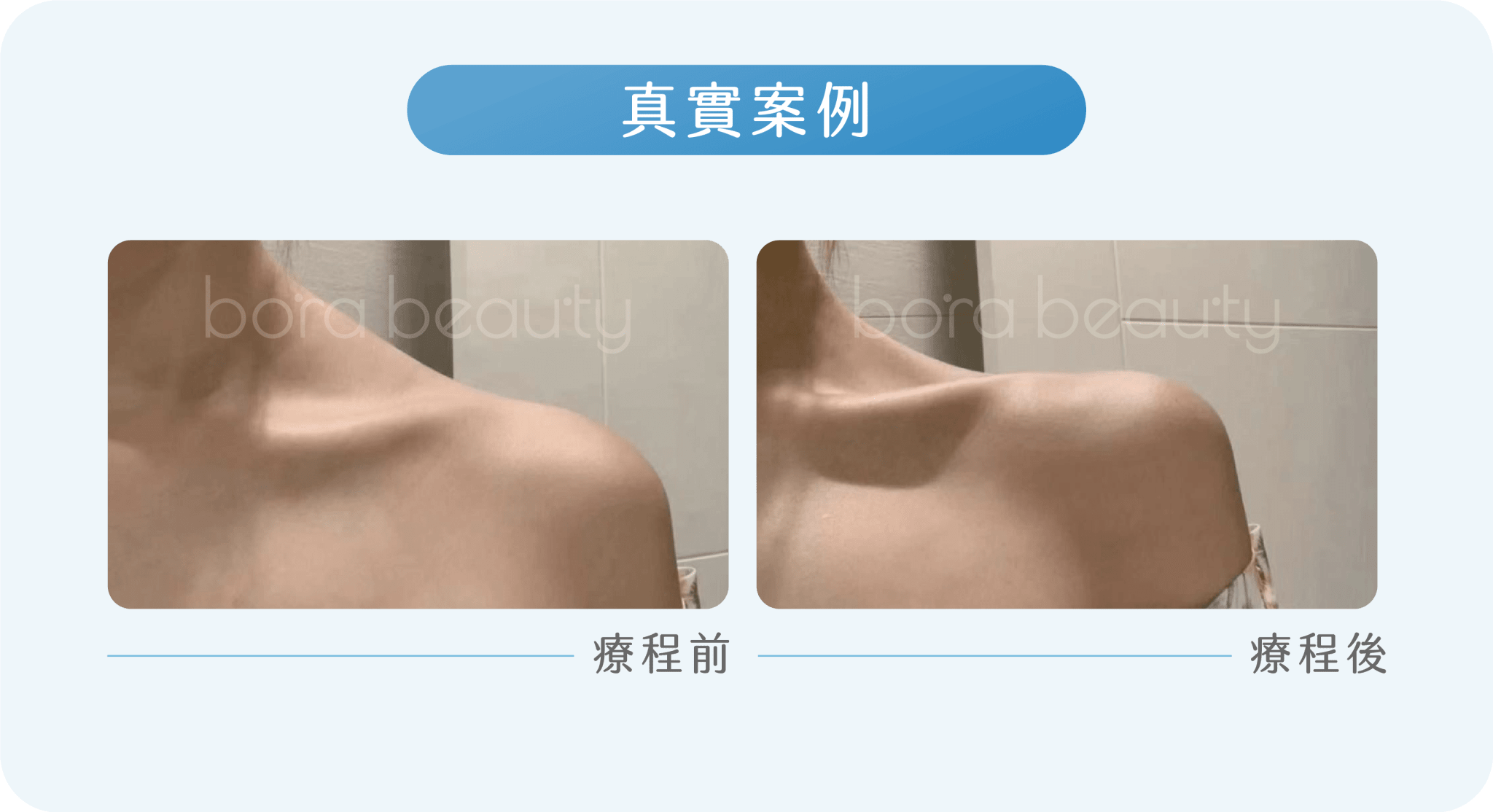 Xeomin效果：